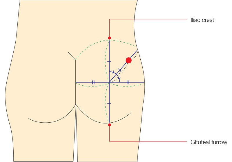 gluteale-intramusculaire-injectie-trainingsmodel-2