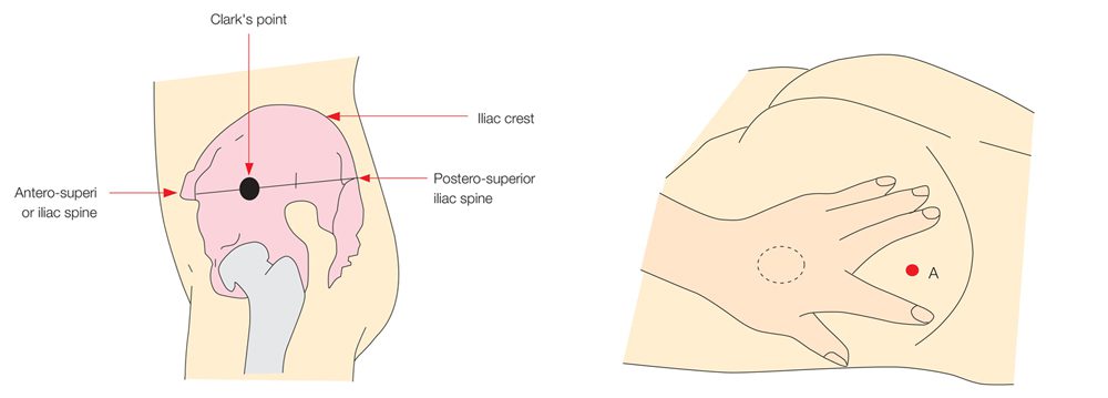 gluteale-intramusculaire-injectie-trainingsmodel-type-ii-2